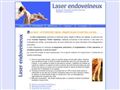 Laser endoveineux, un nouveau traitement des varices.